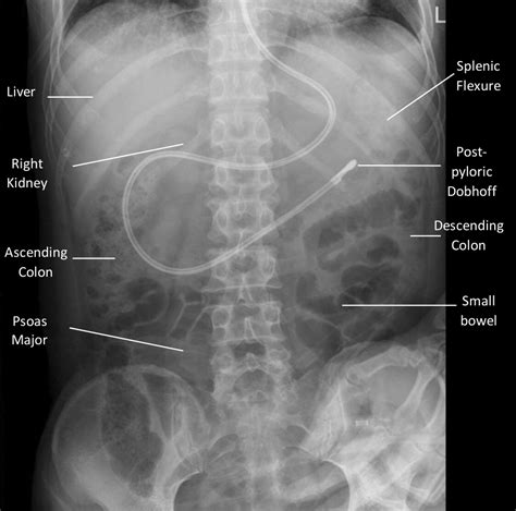 kub medical abbreviation|KUB .